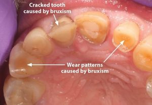 Bruksizam - Izgled zuba nastao kao posledica skripanja zuba