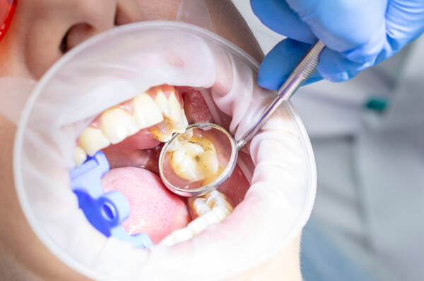 Karijes zuba uocen na stomatoloskom pregledu