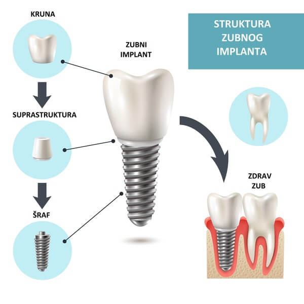 Ilustracija strukture zubnih implanta i postupak ugradnje