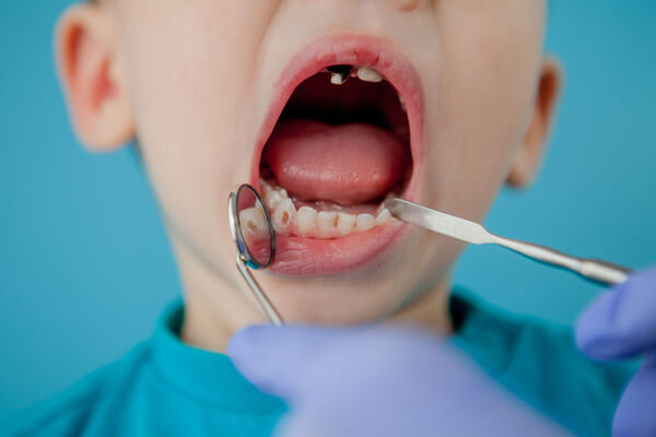 Uocen karijes kod deteta i pokvaren zub