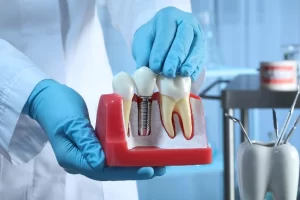 Zubni implant i prirodni zubi na demonstracionom modelu