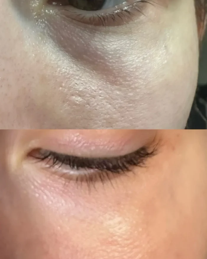 Hijaluronski-fileri-izgled-pre-i-posle-700x874 Anti-aging-tretman-pre-i-posle-300x300