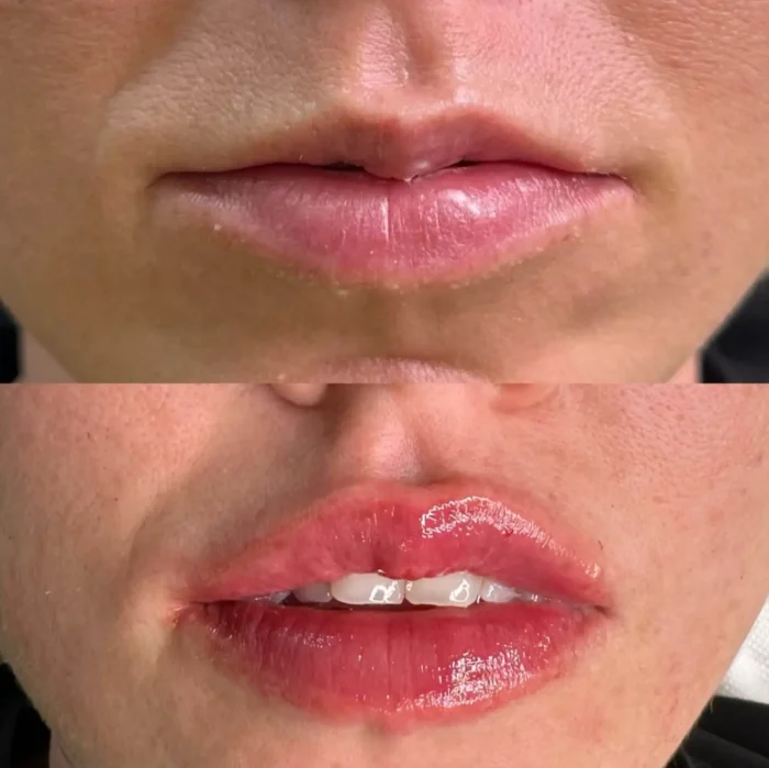 Hijaluronski-fileri-za-usne-izgled-pre-i-posle-700x699 Anti-aging-tretman-pre-i-posle-300x300