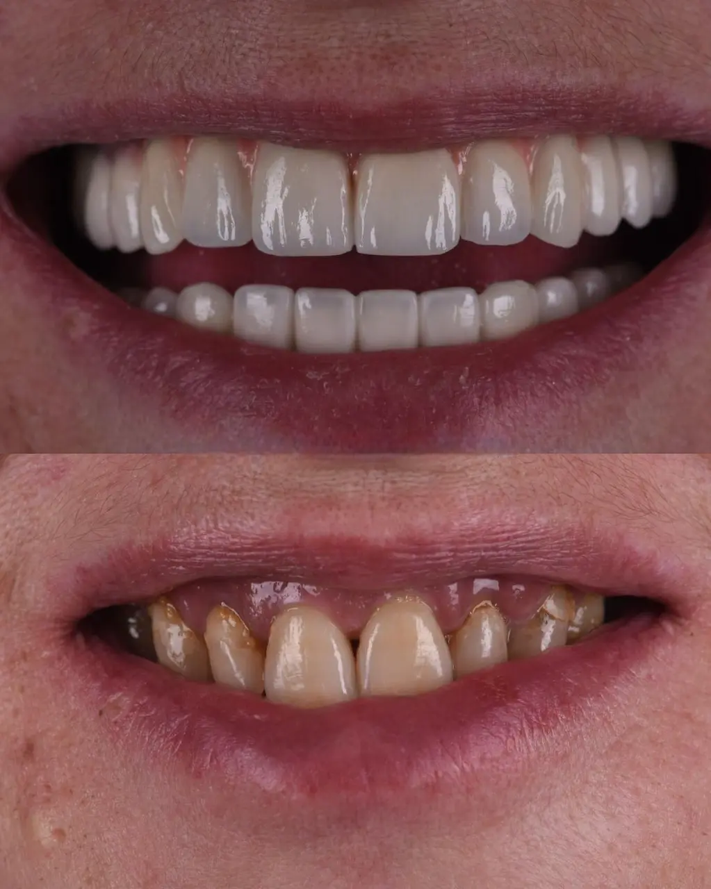 Anti-aging-tretman-pre-i-posle-300x300