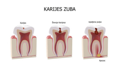 Karijes – uzroci, simptomi, prevencija, lečenje