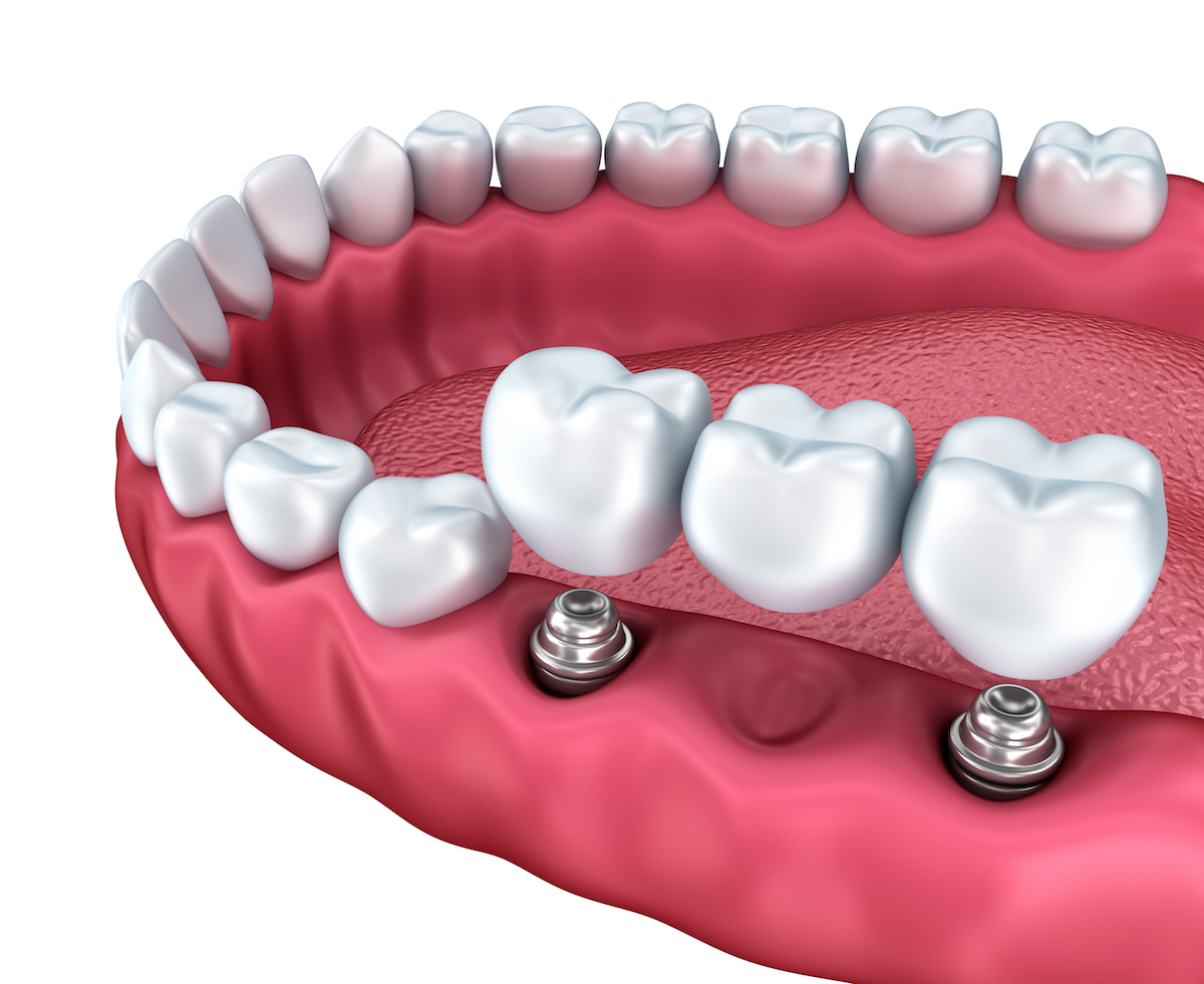 A close-up view of lower teeth and dental implants isolated on white Ilustracija strukture zubnih implanta i postupak ugradnje end